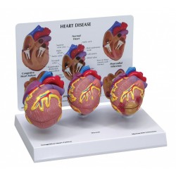Sada mini modelů onemocnění srdce