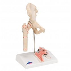 Kyčelní kloub s osteoartrózou a zlomenou stehenní kostí