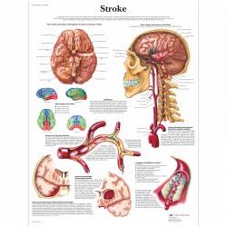 Cévní mozková příhoda - 50 x 67 cm plakát anatomie / papír bez lišt