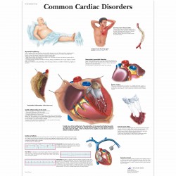 Běžné onemocnění srdce - 50 x 67 cm plakát anatomie / papír bez lišt
