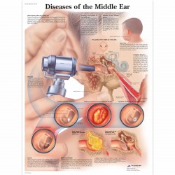 Nemoci středního ucha - 50 x 67 cm plakát anatomie / papír bez lišt