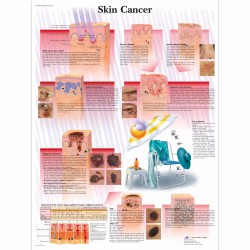 Rakovina kůže - 50 x 67 cm plakát anatomie / papír bez lišt