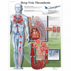Trombóza  - 50 x 67 cm plakát anatomie / papír bez lišt