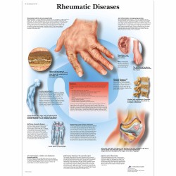 Revmatické onemocnění - 50 x 67 cm plakát anatomie / papír bez lišt