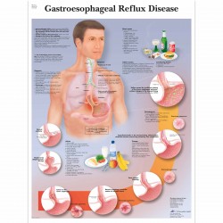 Nemoci jícnu GERD - 50 x 67 cm plakát anatomie / papír bez lišt